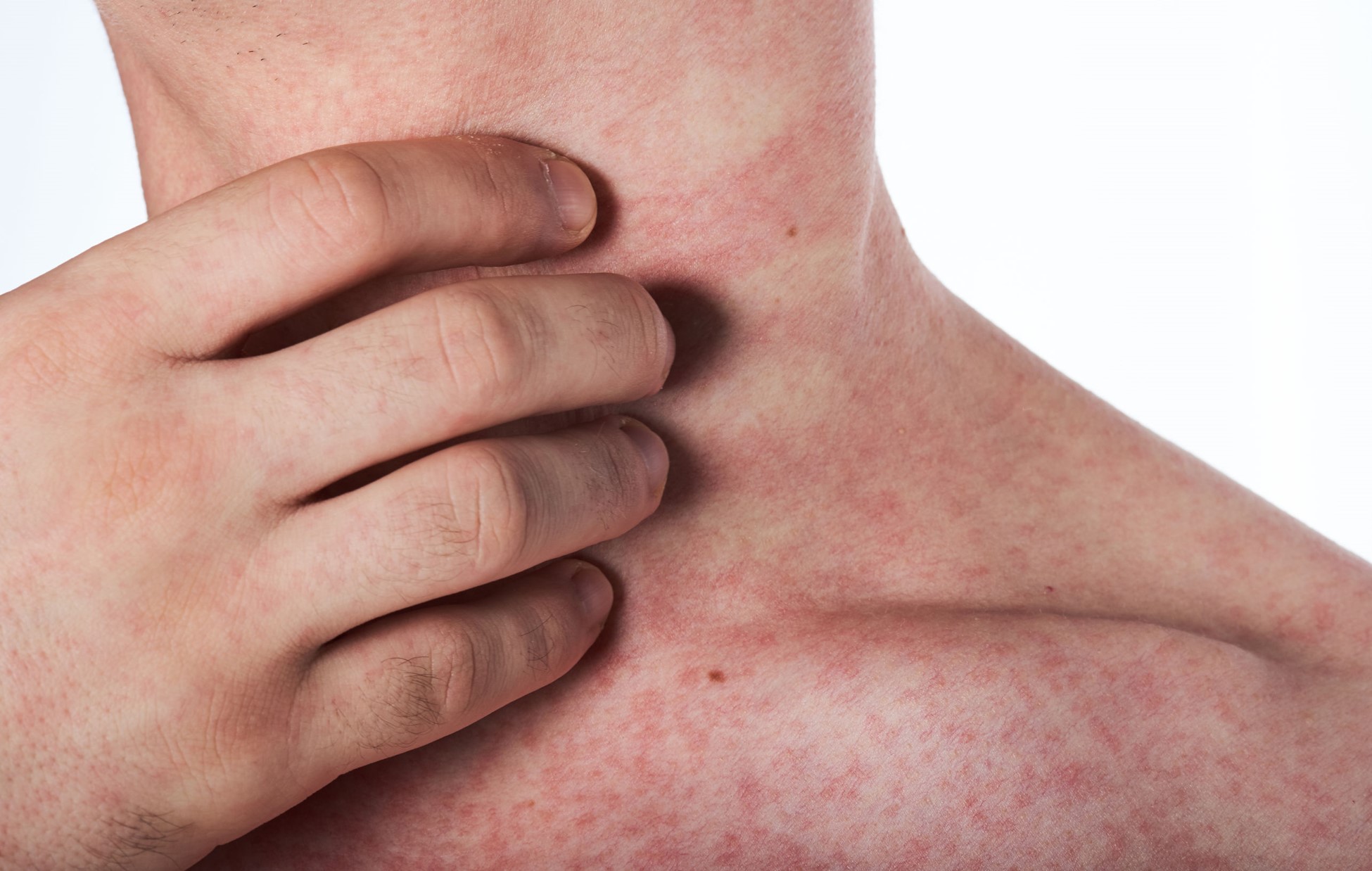 Skin Rashes is a Sign of Chronic Inflammation